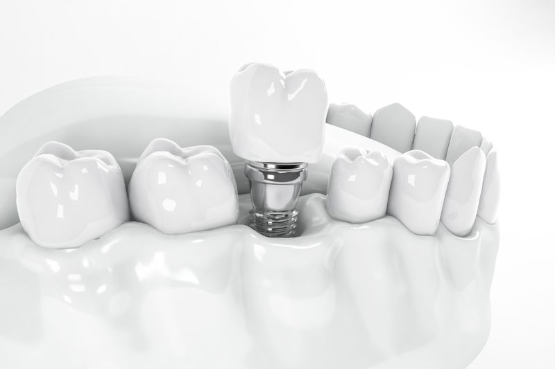 What are the Possible Side Effects of Dental Implants?