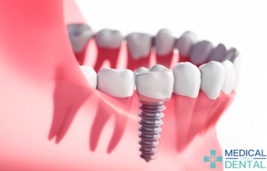 How long do dental implants last?